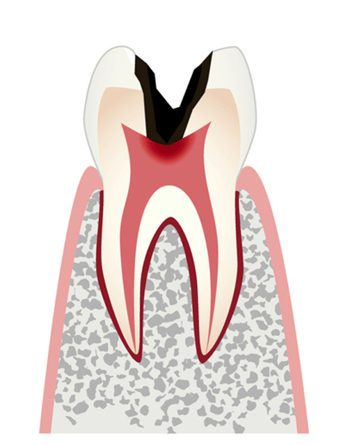 神経（歯髄）まで進行した虫歯